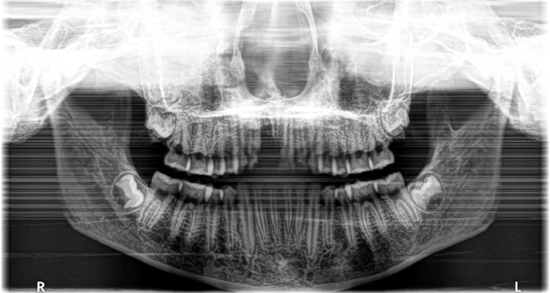 M14的口部X光片，根據智齒尚未萌發與第二大臼齒牙根未閉合，判斷死亡年齡為15–16歲