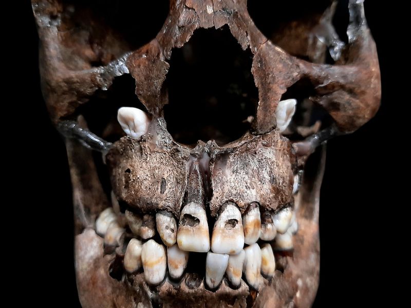 M 22（12-14歲）犬齒萌發位置異常，導致門齒齲齒。(圖/陳志誠)