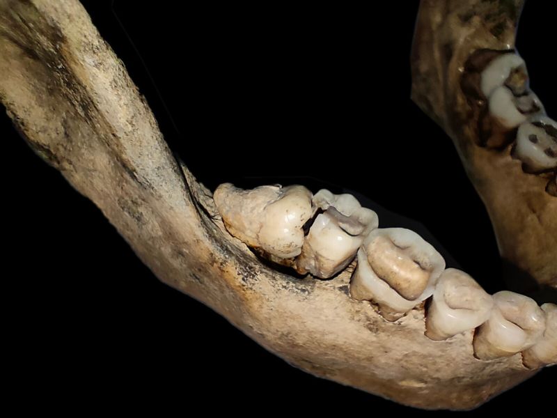 M 13（20-23歲）下頜大臼齒齲齒。(圖/陳志誠)