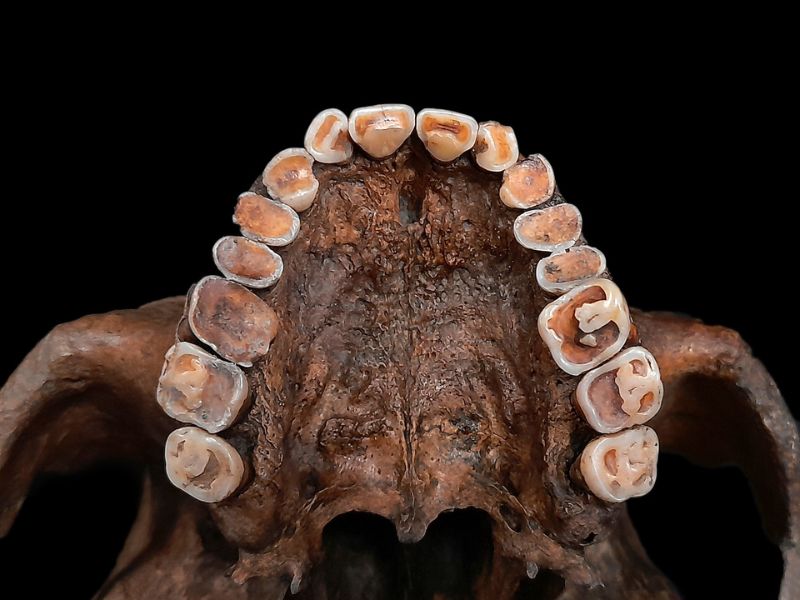 M 9（30-35歲）牙齒重度磨耗。(圖/陳志誠)